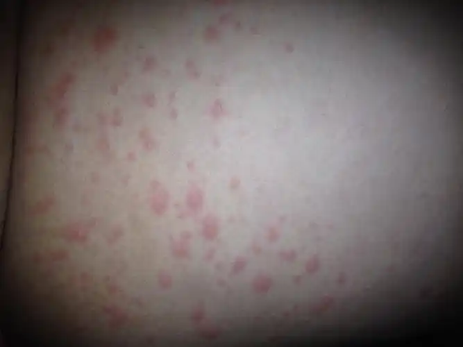 身上有红疙瘩很痒?这种皮肤病恐怕是狐臭引起的!