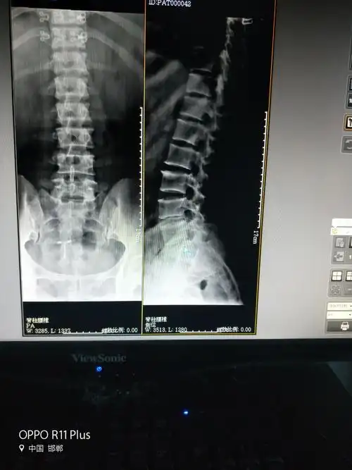 林北骨科诊所新进放射cr数字成像系统,对颈腰椎,四肢关节拍片清楚.