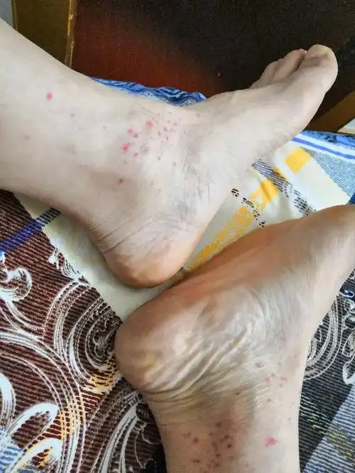 一两天脚上长有红点点也不痛不痒是怎么回事?