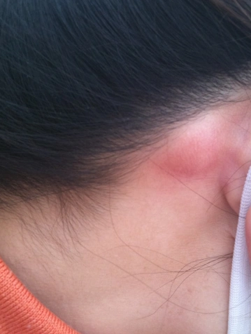 手臂皮下脂肪瘤图片