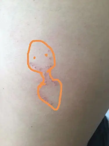 会不会是无毒蛇咬的?画了个蛇嘴的形象图,是不是蛇咬的很象啊.