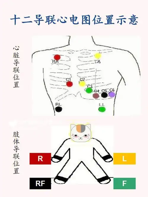 正确做心电图非常的重要喔.注意导联位置和颜色区分.