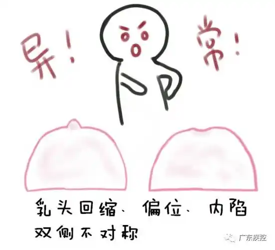 外形像人脸颊上的酒窝,也叫"酒窝征"