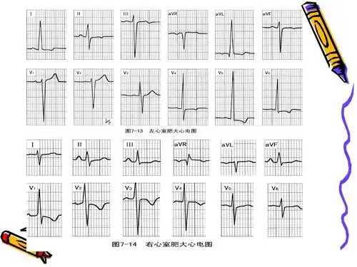 常见异常心电图ppt