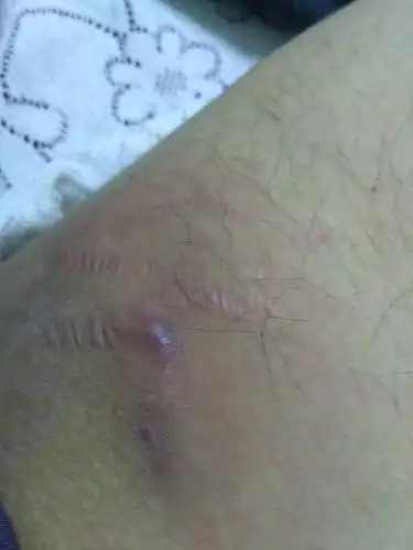 昨天晚上睡觉时突然发现大腿内侧肿块表面皮肤中心有点紫黑周