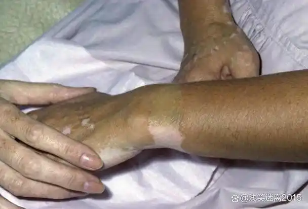 得了白癜风,皮肤一片片变白,会不会传染给别人?医生科普