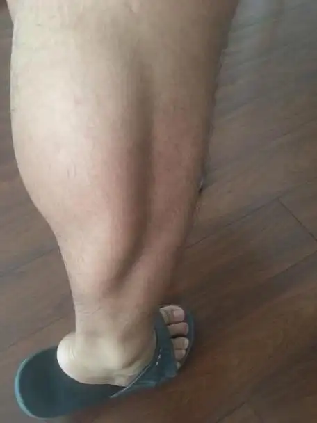 有人认为跑步会让腿部变粗,而事实上对于大多数小腿粗的情况,多是由于