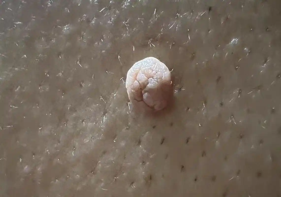 长这个肉疣是什么原因,传染吗?需要手术吗?