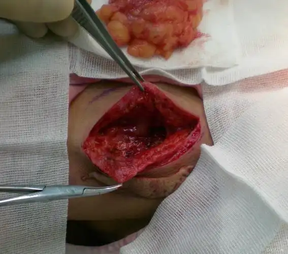 【 资源】背部脂肪瘤切除—真皮瓣填充