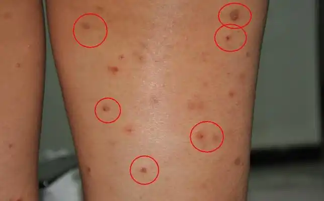 艾滋病红点图片 (47)