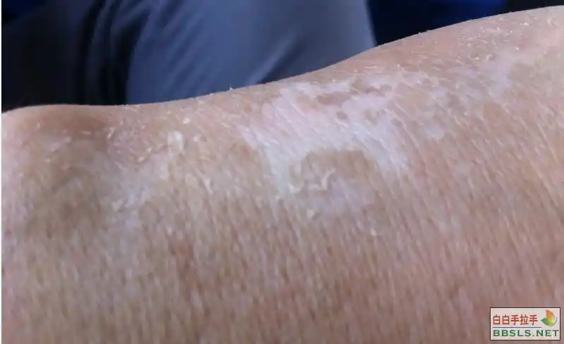 李博士你好,请问我手背是花斑藓还是白癜风?