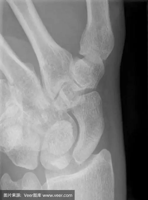 手腕正常舟状骨的x光片