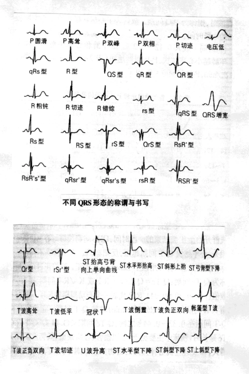 心电图各波形态