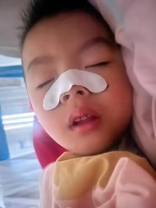 腺样体面容的孩子,应该如何来调理?