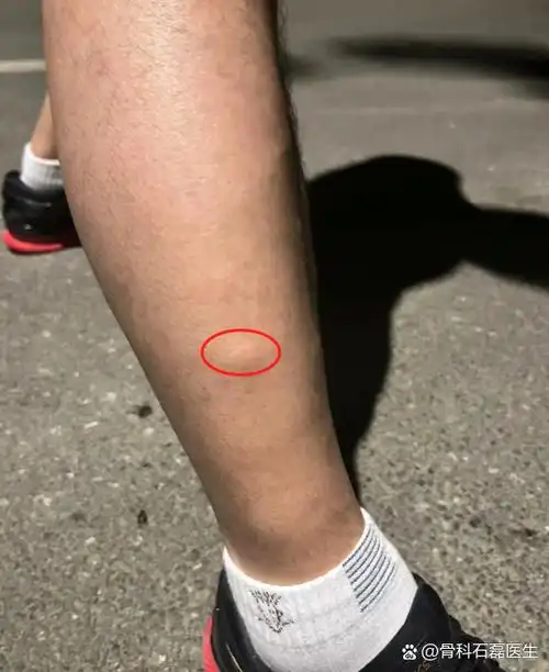 可能是正常肌肉收缩,但也可能是腱鞘囊肿,肌疝或外伤引起的