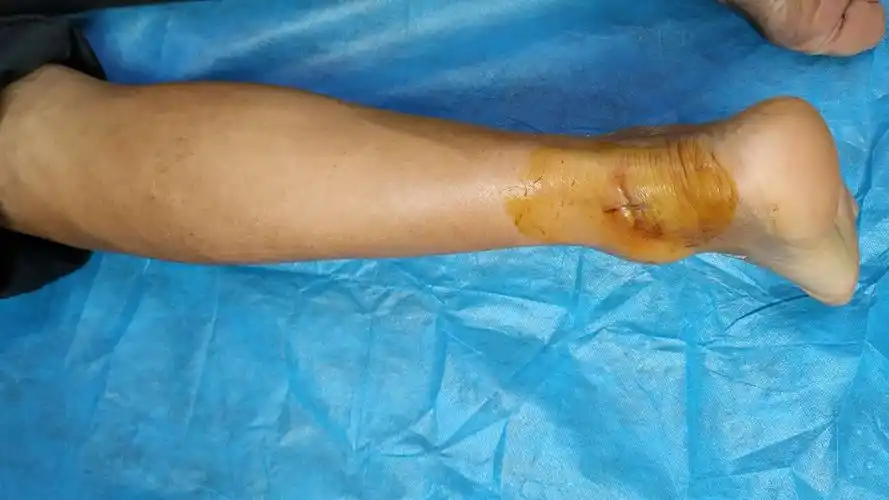 蛇咬伤,蜂蛰伤我们更专业! ——南石医院急诊团队