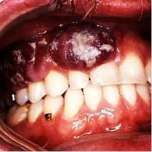 案例分享艾滋病患者的口腔特征牙医操作务必谨慎