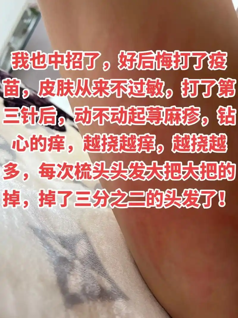 我也中招了,好后悔打了疫苗,皮肤从来不过敏,打了第三针后,动 - 抖音