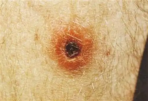 余大爷的大腿上被恙虫叮咬,出现焦痂.