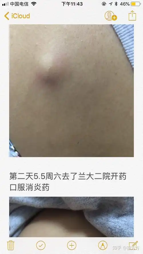 原来我长的不是疖子而是皮脂腺囊肿又称粉瘤