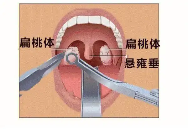 扁桃体肿大怎么办?用好4招.有效调理