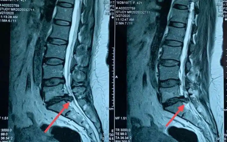 党参,对腰椎间盘突出或许有一定的缓解作用,制没药12g.