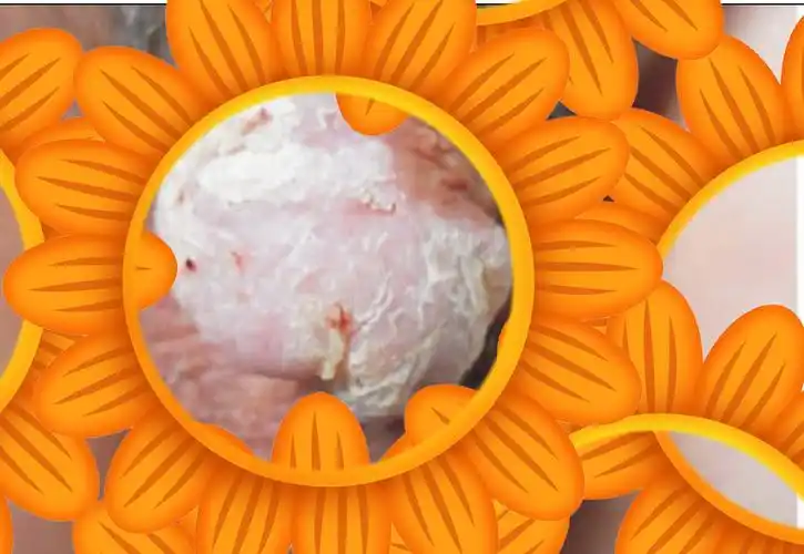 丁丁上的雀斑--云母状角化性假上皮瘤性龟头炎_包皮龟头炎_介绍_检查