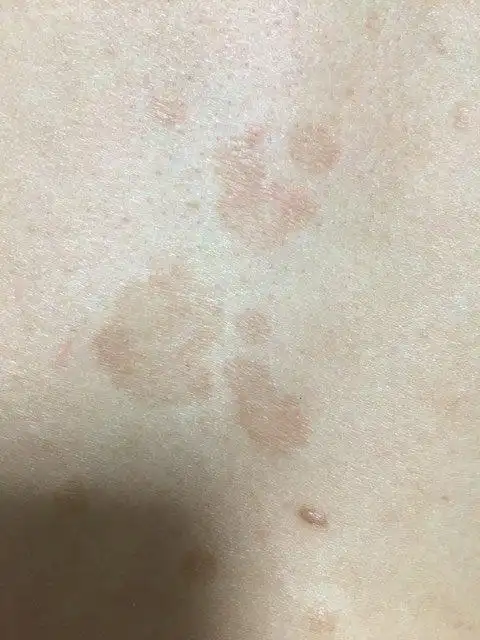 哪位医生能告诉我?老公身上的,是汗斑还是癣