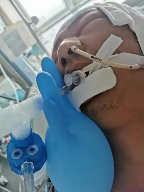 一例气管插管引起的唇部压力性损伤的案例分析