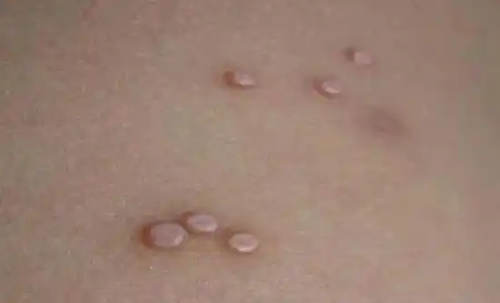 皮肤病课堂皮肤疣的种类及防治事项