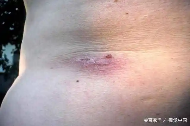 4,不明原因的出血症状 癌症组织的快速生长,会侵犯人体的血管,极易