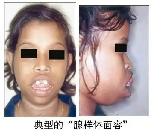 不敢去表现自己,从而导致孩子失去了很多机会,而且腺样体肥大严重影响