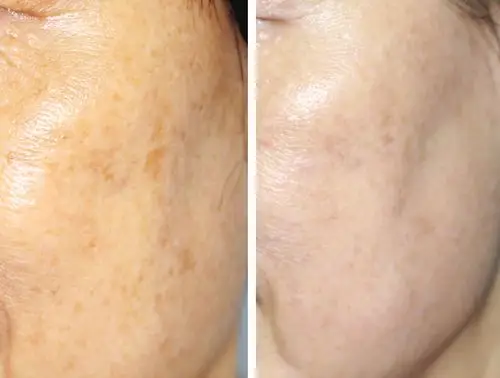 而且对雀斑,晒斑,太阳班,老人斑,咖啡牛奶斑特别有效.