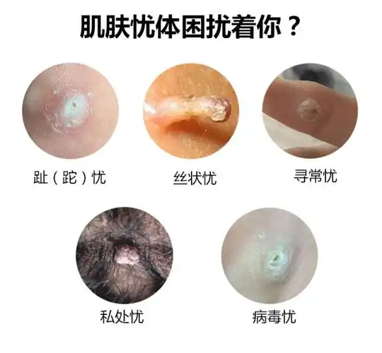 官方旗舰草本平灵液霜疣瘊平hpv疣去老茧除疣扁呯疣瘊净鸡膏眼老茧