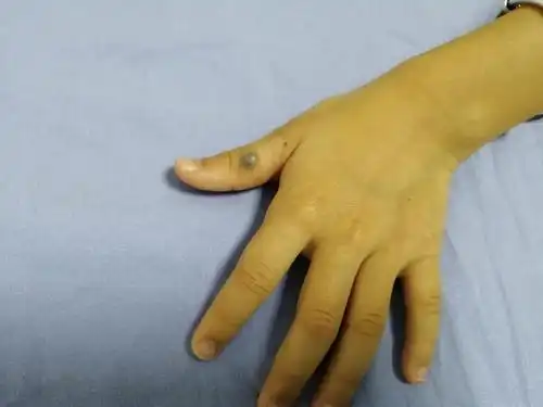 惊!铅笔插入孩子手指长出"肉芽肿"