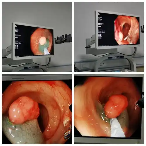 我院顺利开展首例内镜下肠息肉电凝电切术 - 美篇