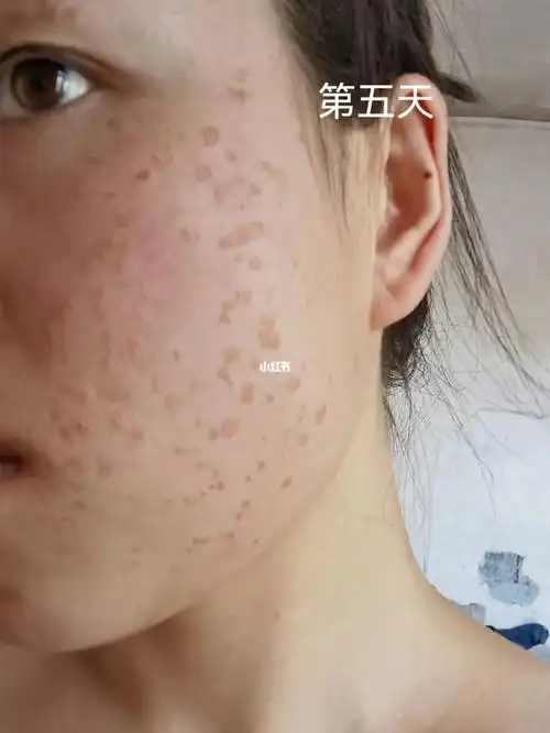 治疗扁平疣太难了 什么时候能好啊_扁平疣_中药_医疗健康_医疗健康