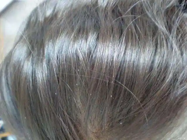 耳后发根上,多见于卫生条件差的妇女和儿童,在头发处易发现头虱和虱卵