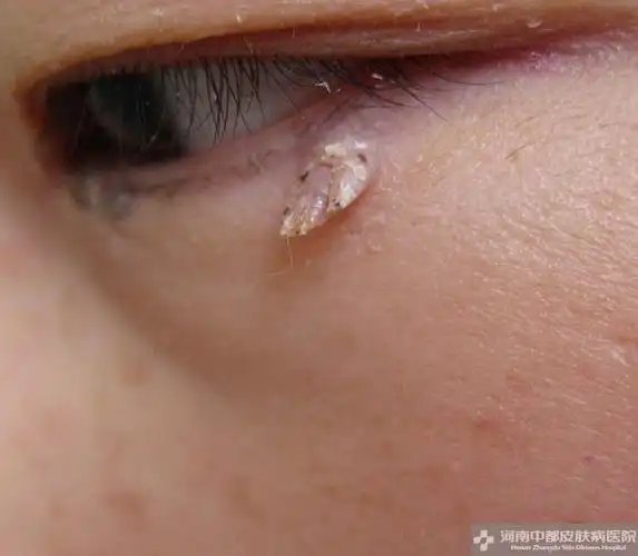 手疣的容易混淆的疾病