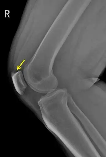 今天学习一下小髌骨,髌骨是人体最大的籽骨,呈扁粟状,上髋为髌骨