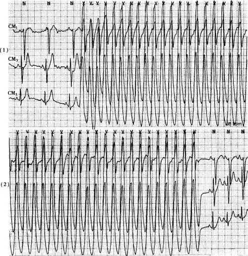 特发室性心动过速.