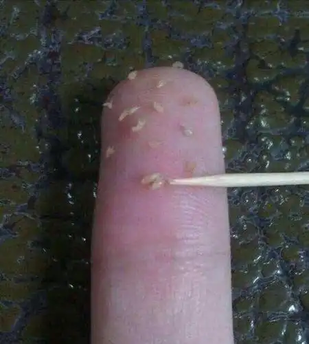 是螨虫排出的粪便,简直太恶心了!_毛细孔