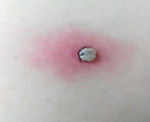 (扎入皮肤之后,吸血的蜱虫变成肤色.受访者供图)