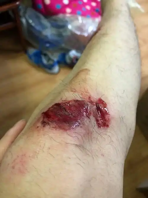 骑车时摔了一下,腿受伤了 怎么处理好的快