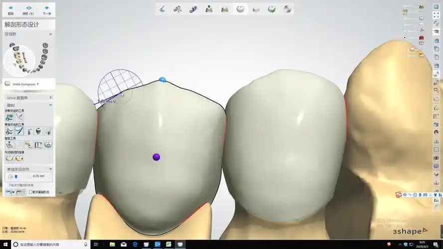 中文版后牙内冠桥体设计3shape_哔哩哔哩_bilibili
