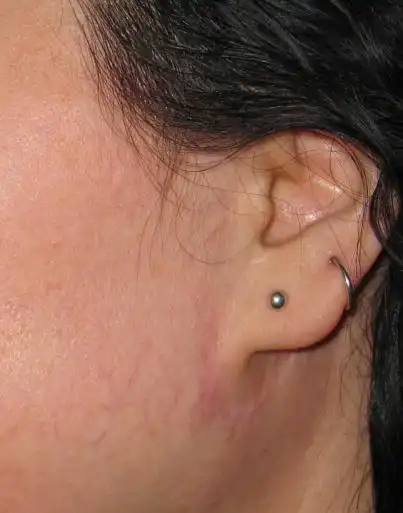 大拉皮手术恢复后会有疤痕吗? - 好大夫在线