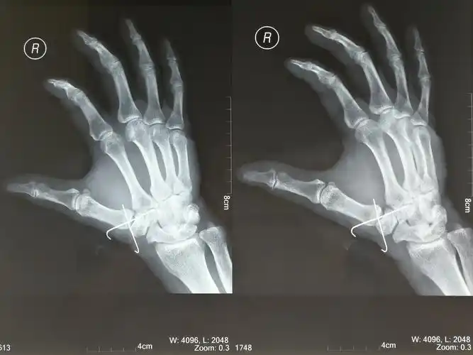 本耐氏bennett骨折即第一掌骨基底部骨折伴脱位