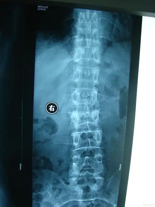 患者,女,55岁 第二腰椎爆裂性骨折