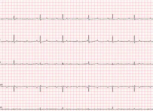 三度房室传导阻滞请老师指导