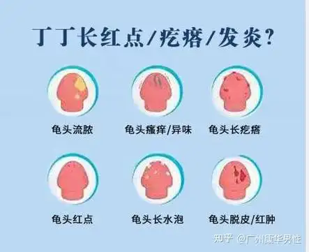 龟头上长有红点是怎么回事番禺男科科普